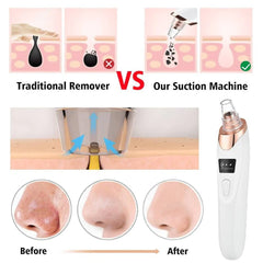 5 in 1 Blackhead Remover | Derma Suction | Rechargeable